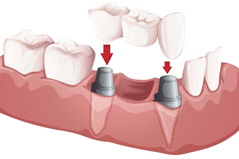 Dental Bridges 3D