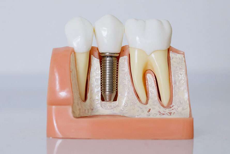 Dummy Dental Implant
