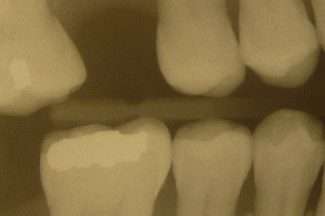 X - Ray of Teeth