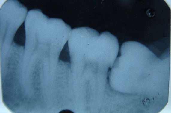 X - Ray of Teeth