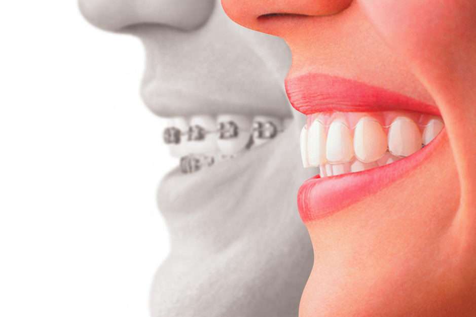 Invisalign Teeth and After Invisalign