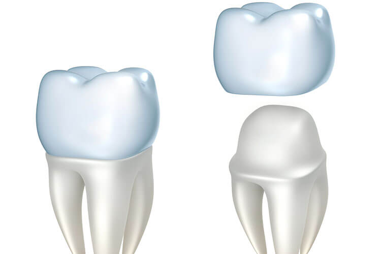 Dental Crown Procedure in Boise ID Area