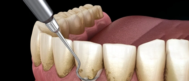 Dental crown placement procedure showing tooth preparation and ceramic crown restoration on natural teeth.