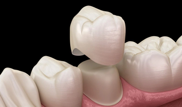 Dental crowns displayed on pink gum model showing tooth restoration procedure.