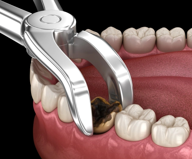 Dental implant procedure showing surgical tool inserting artificial tooth into jawbone with adjacent teeth visible.