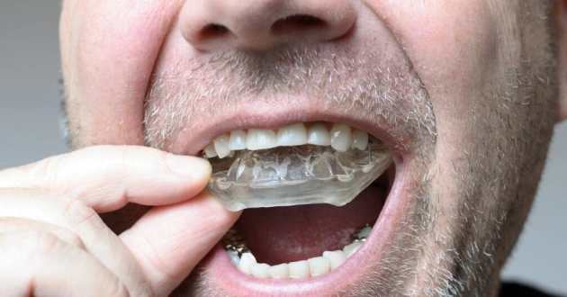 Man inserting clear dental aligner into mouth, demonstrating orthodontic treatment application.